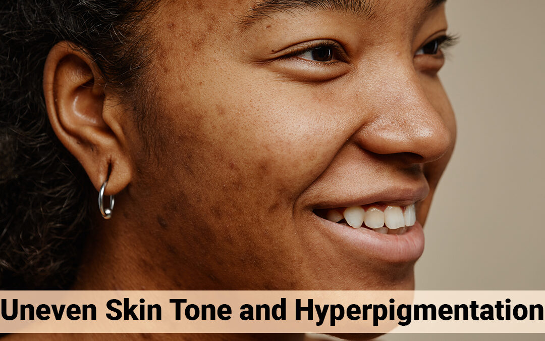 The Best Solutions for Uneven Skin Tone and Hyperpigmentation