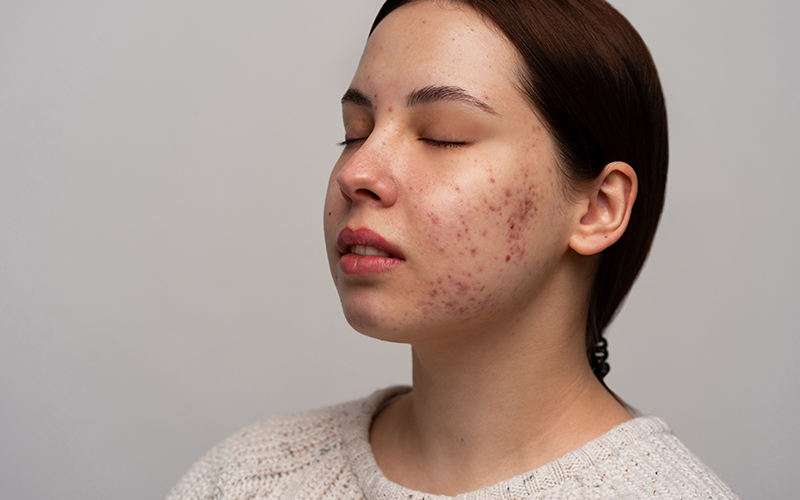 10 Food Items That Can Help You Manage Acne